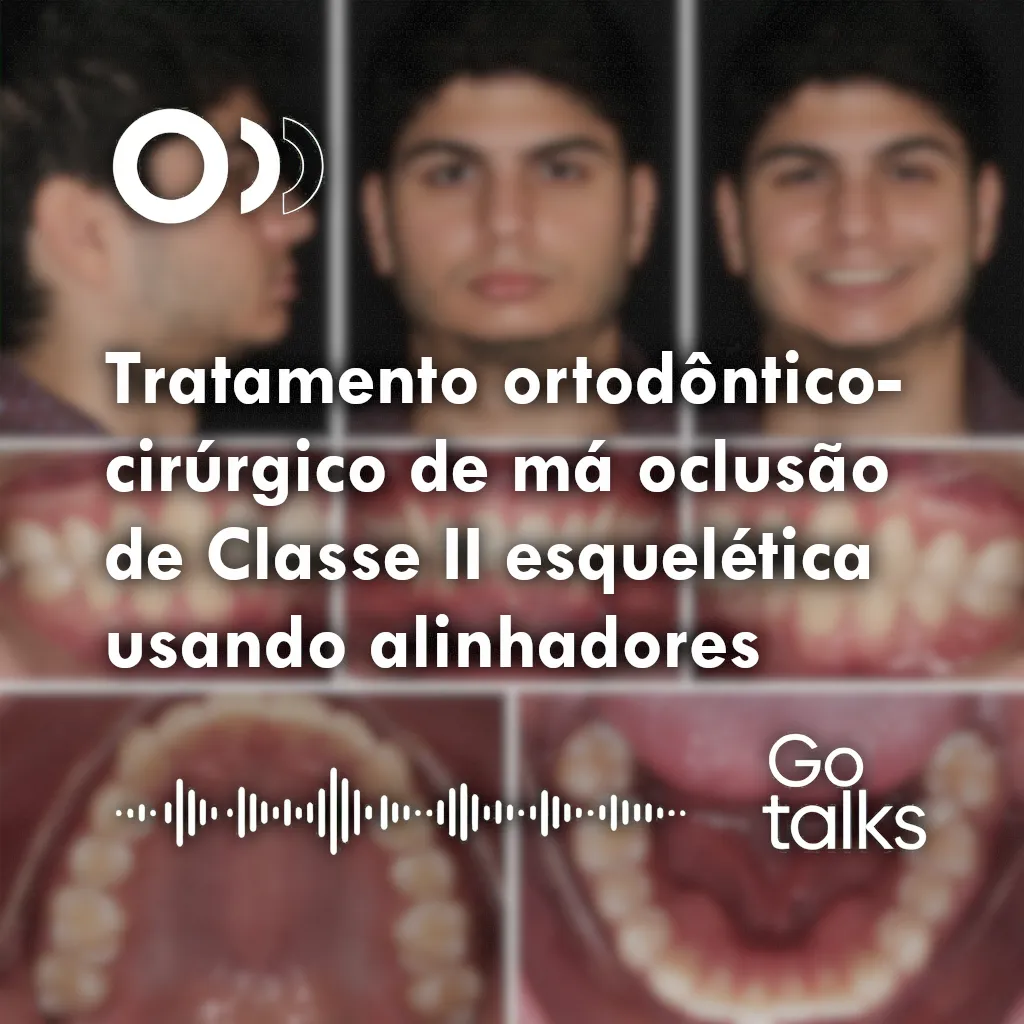 Tratamento ortodôntico-cirúrgico de má oclusão de Classe II esquelética usando alinhadores