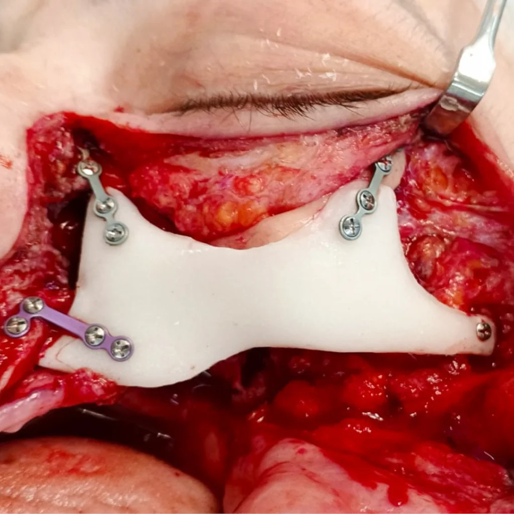 Facial reconstruction after cancer treatment, with polymethylmethacrylate