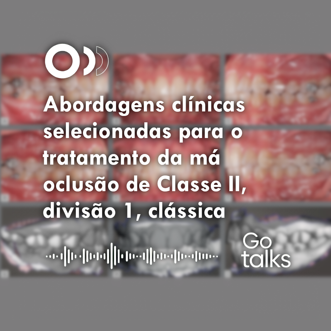 Abordagens clínicas selecionadas para o tratamento da má oclusão de Classe II, divisão 1, clássica