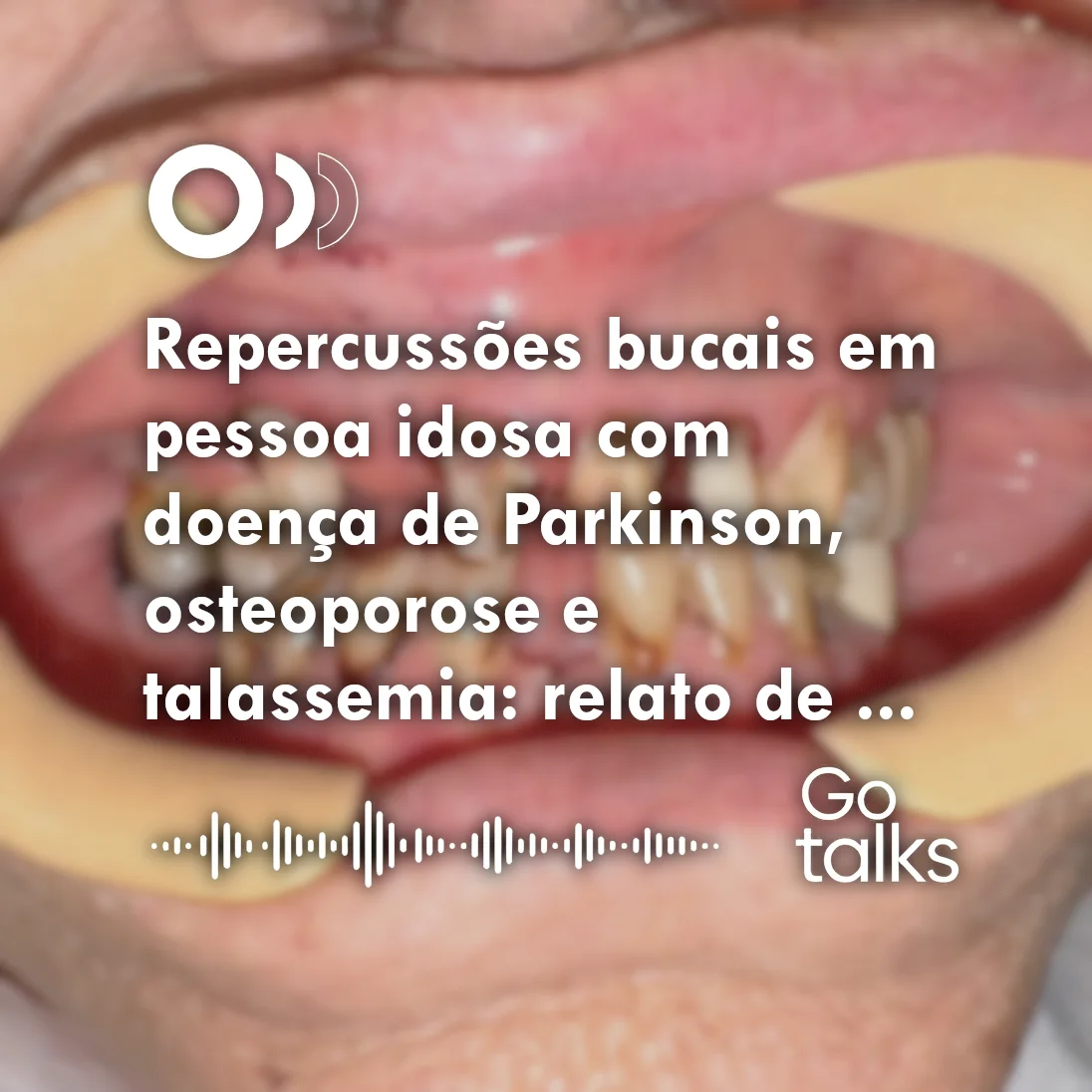 Repercussões bucais em pessoa idosa com doença de Parkinson, osteoporose e talassemia: relato de caso