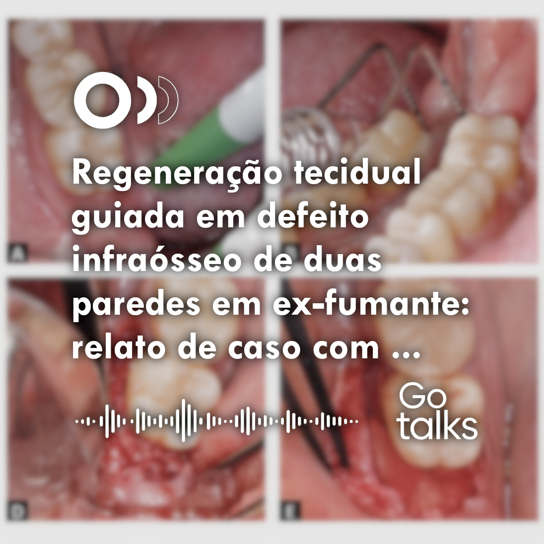 Regeneração tecidual guiada em defeito infraósseo de duas paredes em ex-fumante: relato de caso com avaliação clínica e radiográfica após seis meses